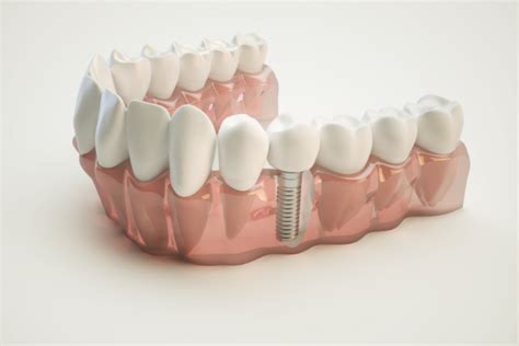 Implants — River Valley Dental.